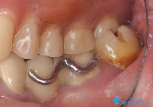 【セラミックインレー】詰め物が外れたので綺麗にしたいの治療前