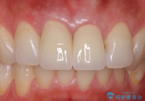 変色した歯を綺麗にしたい 根管治療からジルコニアクラウンでの修復の治療後