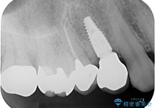 【インプラント】2ヵ月前から歯に違和感があるので診て欲しい!　歯根破折の治療後