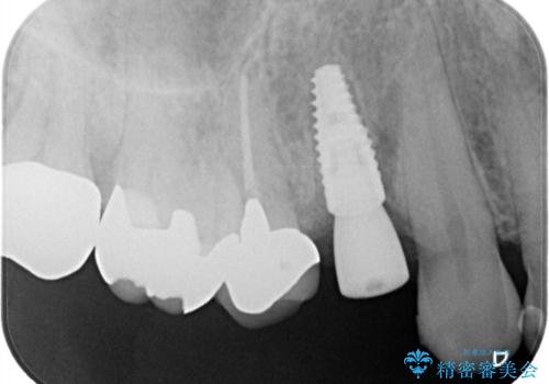 【インプラント】2ヵ月前から歯に違和感があるので診て欲しい!　歯根破折の治療中
