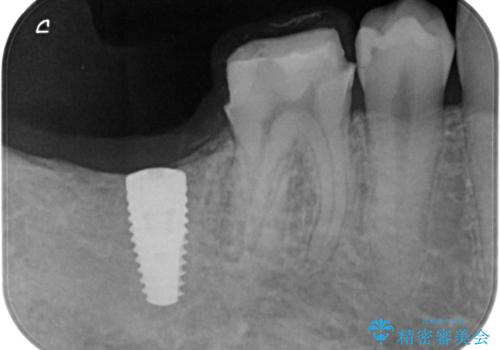 銀歯を白くしたい。(インプラント治療)の治療中