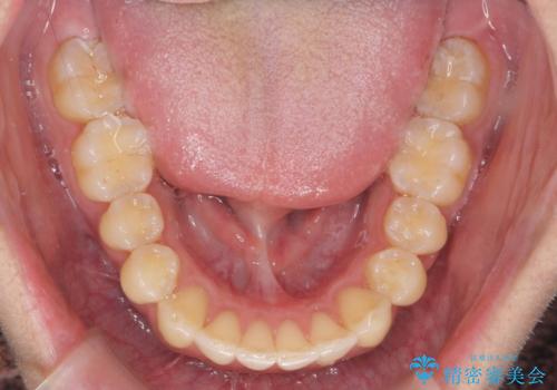 過蓋咬合・上顎前突・叢生を改善するマウスピース矯正の治療後