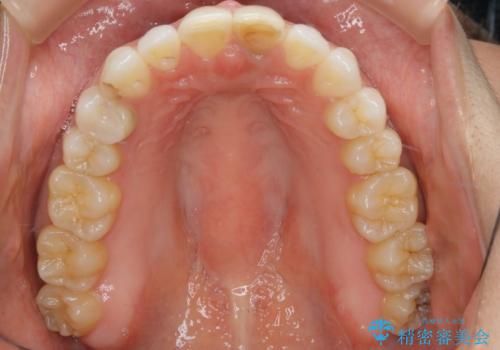 すきっ歯を治したい。インビザライン・ライトによる矯正治療の治療後