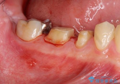 深い虫歯 セラミッククラウンの精度を高める歯周外科手術の治療中
