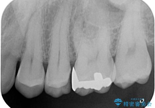 【セラミックインレー】他院で詰めた銀歯がフロスをしたら取れた!の治療前