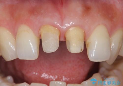 変色した歯を綺麗にしたい 根管治療からジルコニアクラウンでの修復の治療中