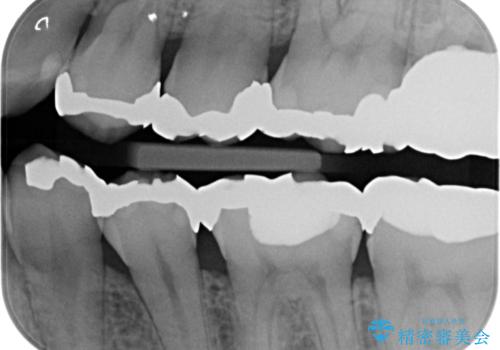 APF(歯肉弁根尖側移動術)の治療前