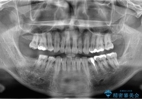 銀歯を白くしたい。(インプラント治療)の治療中