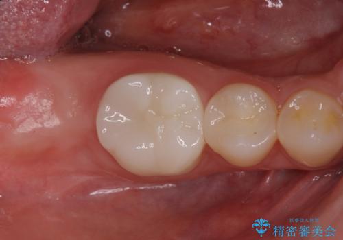 歯がないところにインプラントを入れたいの治療前
