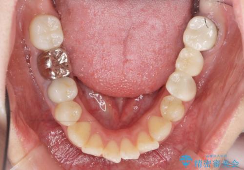 インプラント・セラミック・矯正治療を含む包括歯科診療の治療前
