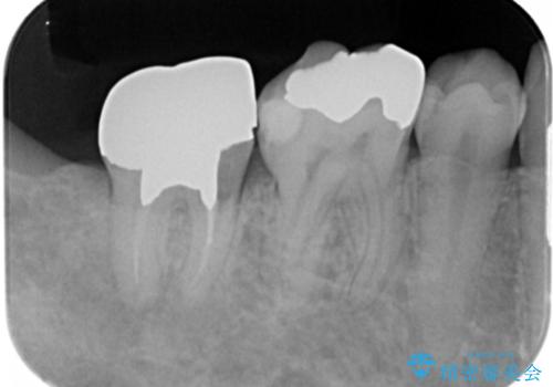 銀歯を白くしたい。(インプラント治療)の治療前