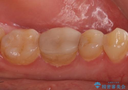 精度の低い詰め物のやり替えの治療前