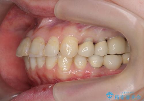 インプラント・セラミック・矯正治療を含む包括歯科診療の治療中