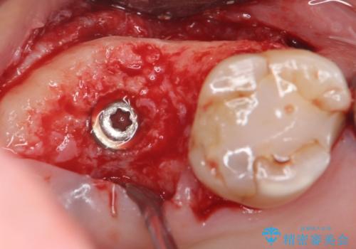 [ 歯槽堤保存術 ] [ 奥歯の破折 ]  ソケットプリザベーションを併用したインプラント治療の治療中