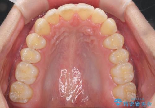 過蓋咬合・上顎前突・叢生を改善するマウスピース矯正の治療後