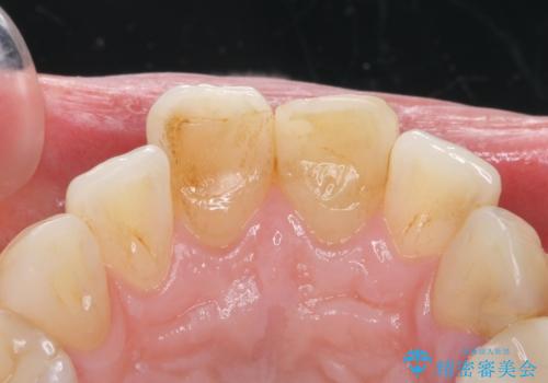 変色した歯を綺麗にしたい 根管治療からジルコニアクラウンでの修復の治療前