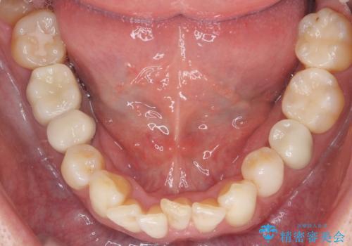 銀歯を白くして見た目を改善したい !の治療後