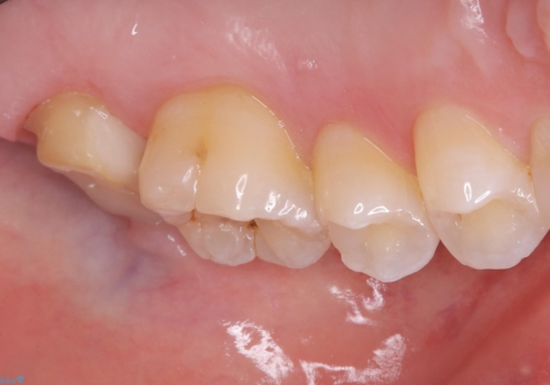 【セラミッククラウン】歯並びも綺麗になったし歯も白くしたいの治療中