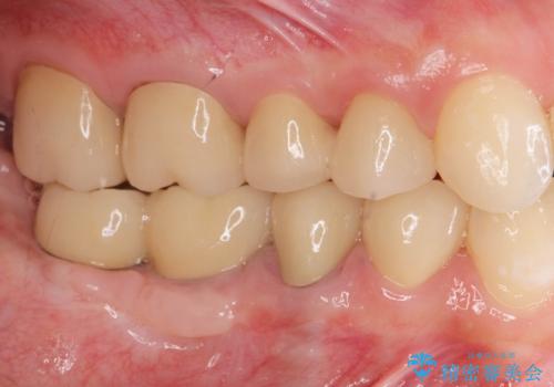 インプラント・セラミック・矯正治療を含む包括歯科診療の治療後