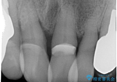 前歯がグラグラする。の治療前