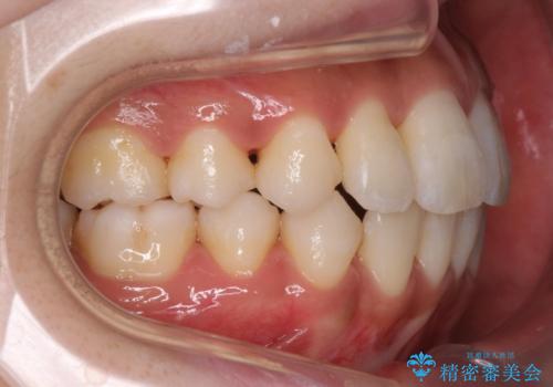 犬歯が歯ぐきにうまっている　真ん中のずれ、出っ歯を治したいの治療後