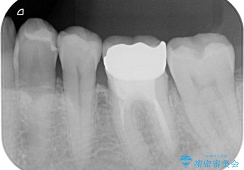 銀歯がとれた セラミックインレーで修復の治療前