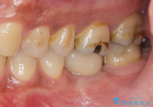 失った奥歯をインプラントで機能回復の治療後