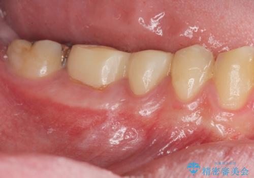 深い虫歯　セラミッククラウンの精度を高める歯周外科手術の症例 治療前