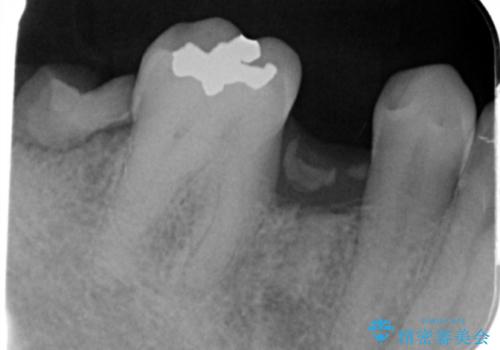 [ 失った歯の機能を回復 ] 奥歯のインプラント治療の治療前