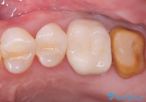 詰め物と歯の境目に汚れが溜まるの症例 治療後