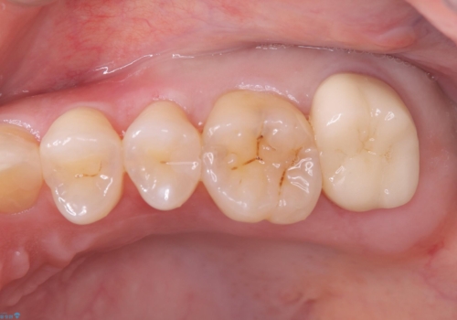 歯並びも綺麗になったし歯も白くしたいの症例 治療後