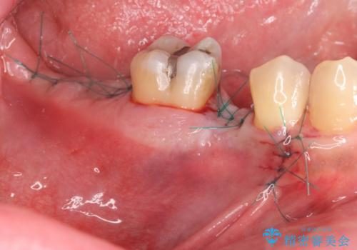 [ 失った歯の機能を回復 ] 奥歯のインプラント治療の治療中
