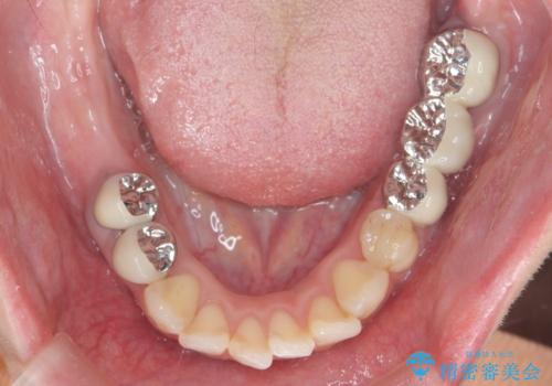 インプラント・セラミック・矯正治療を含む包括歯科診療の治療中