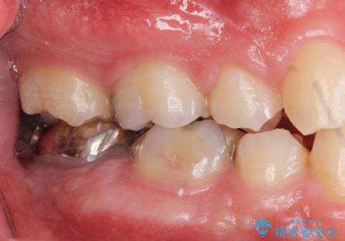 銀歯を白くしたい。(インプラント治療)の治療前