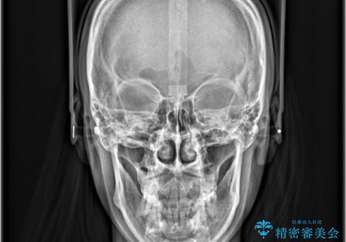 【抜歯矯正】クリア装置で1年半の治療後