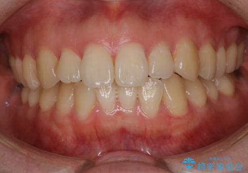 前歯のガタツキをインビザラインで改善の症例 治療前
