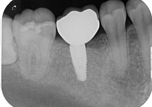 失ったままの臼歯　インプラントによる治療の治療後