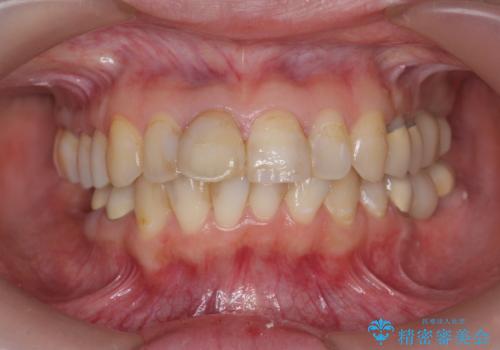 インプラント・セラミック・矯正治療を含む包括歯科診療の治療中