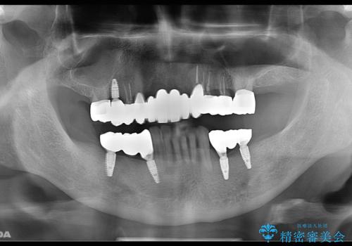 孫から口臭を指摘され来院、全顎治療で噛み合わせ、見た目、口臭全て劇的改善!の治療後