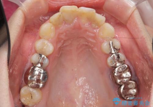 インプラント・セラミック・矯正治療を含む包括歯科診療の治療前