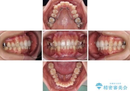 補助装置を用いて奥歯の咬み合わせを事前に改善 インビザラインによる矯正治療の治療中