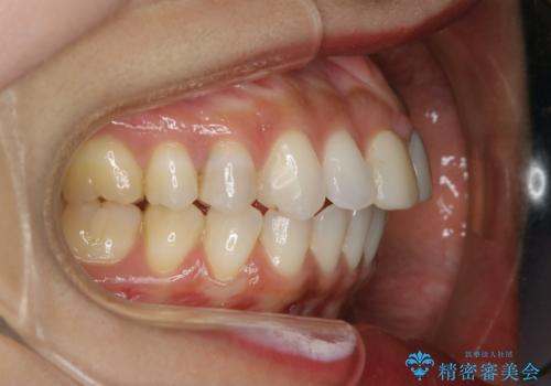 すきっ歯を治したい。インビザライン・ライトによる矯正治療の治療前