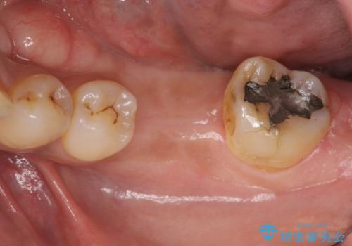 失った奥歯をインプラントで機能回復の治療中