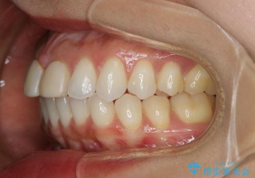 すきっ歯を治したい。インビザライン・ライトによる矯正治療の治療前