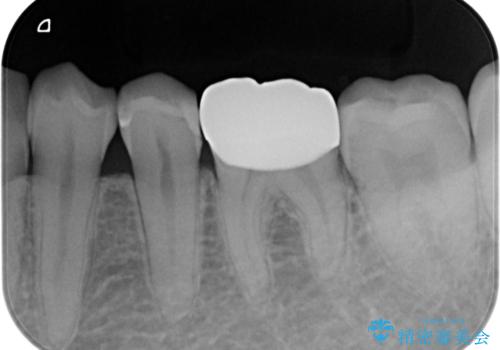 精度の低い詰め物のやり替えの治療後