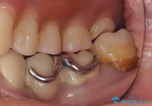 【セラミックインレー】詰め物が外れたので綺麗にしたいの治療後