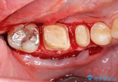 深い虫歯　セラミッククラウンの精度を高める歯周外科手術の治療中