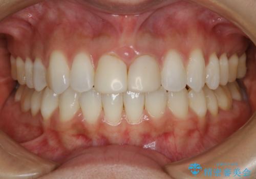 すきっ歯を治したい。インビザライン・ライトによる矯正治療