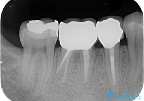深い虫歯 セラミッククラウンの精度を高める歯周外科手術の治療後