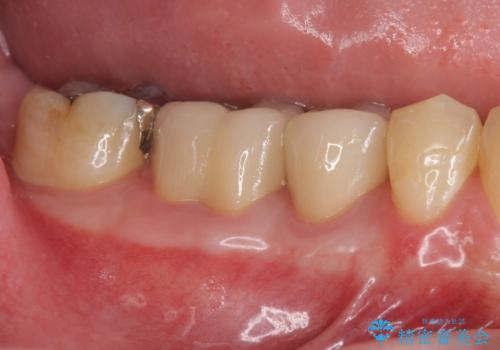 深い虫歯　セラミッククラウンの精度を高める歯周外科手術の症例 治療後